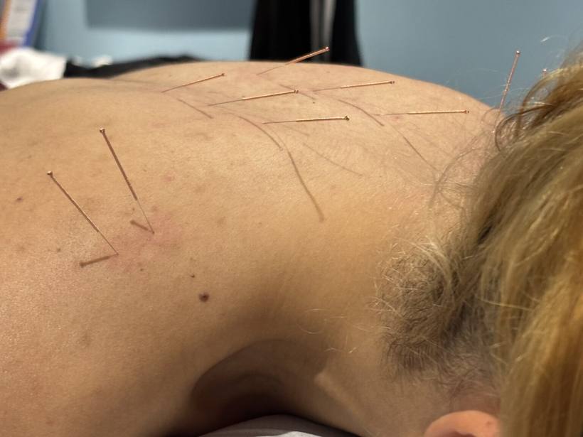 Medical Acupuncture at Milton Keynes Sports Therapy